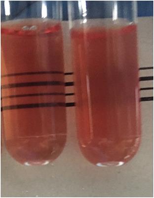 A “One-Stop” Screening Protocol for Haemoglobinopathy Traits and Iron Deficiency in Sri Lanka